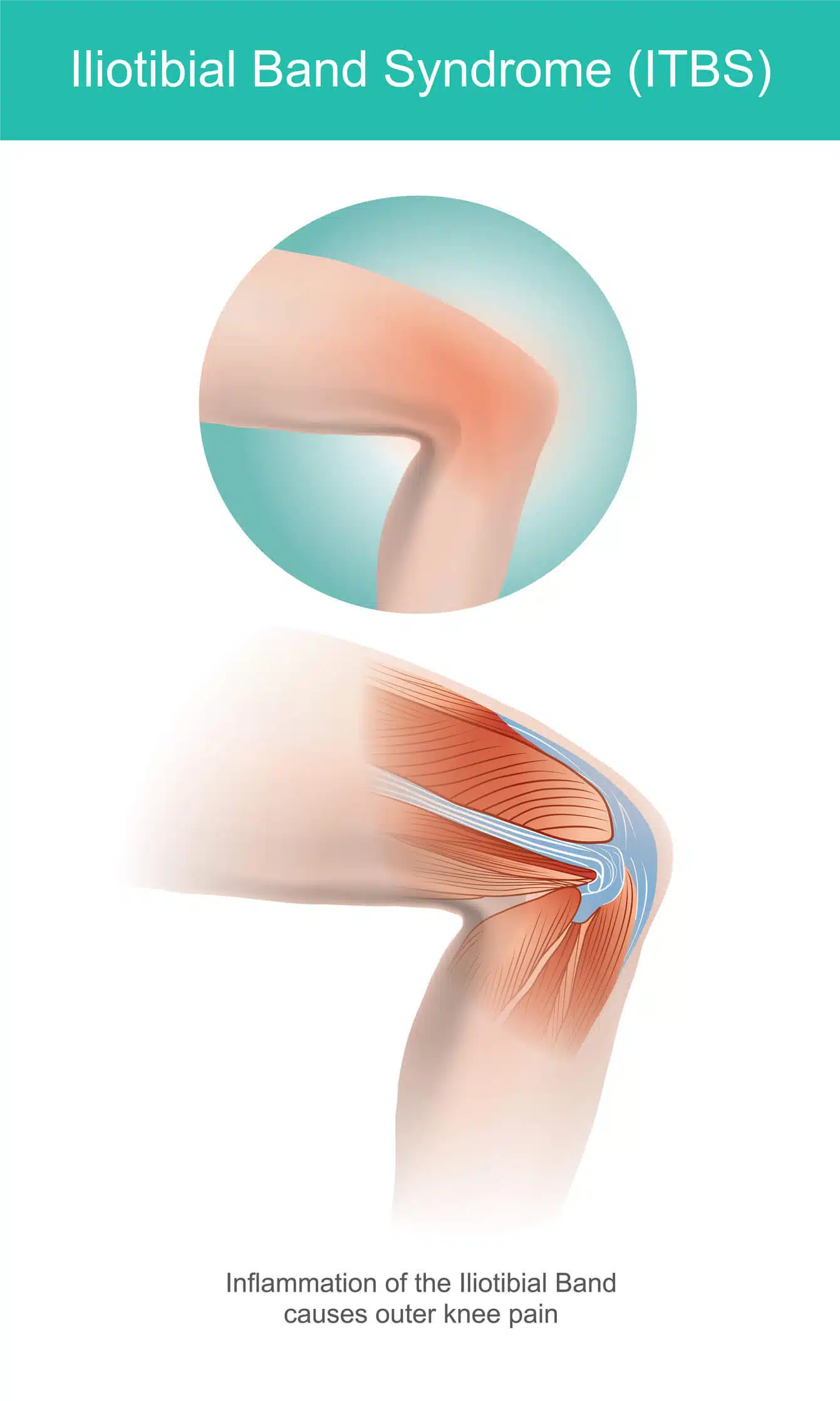 Iliotibial Band Friction Syndrome (ITBFS) - Sports Medicine