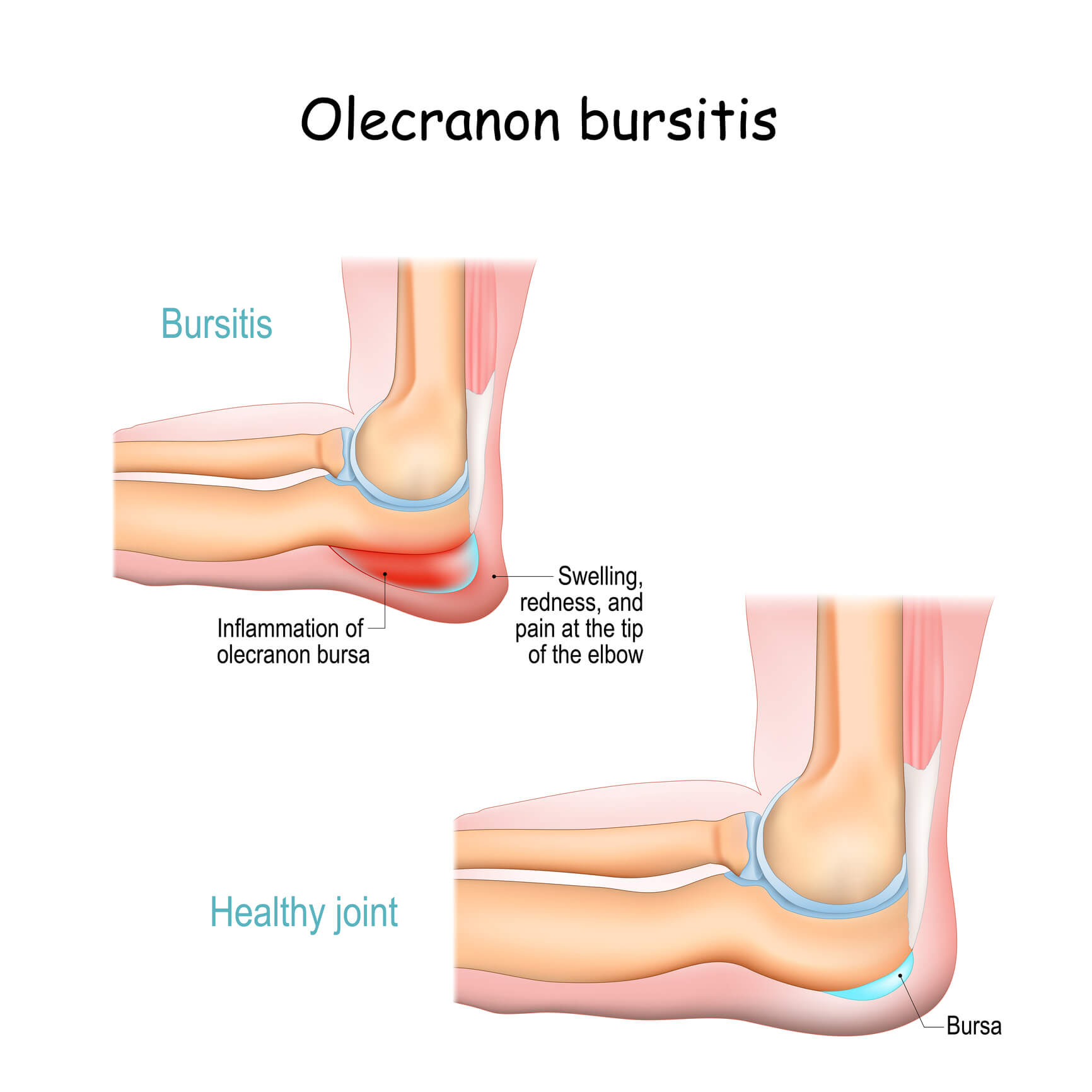 Image of an elbow affected by olecranon bursitis