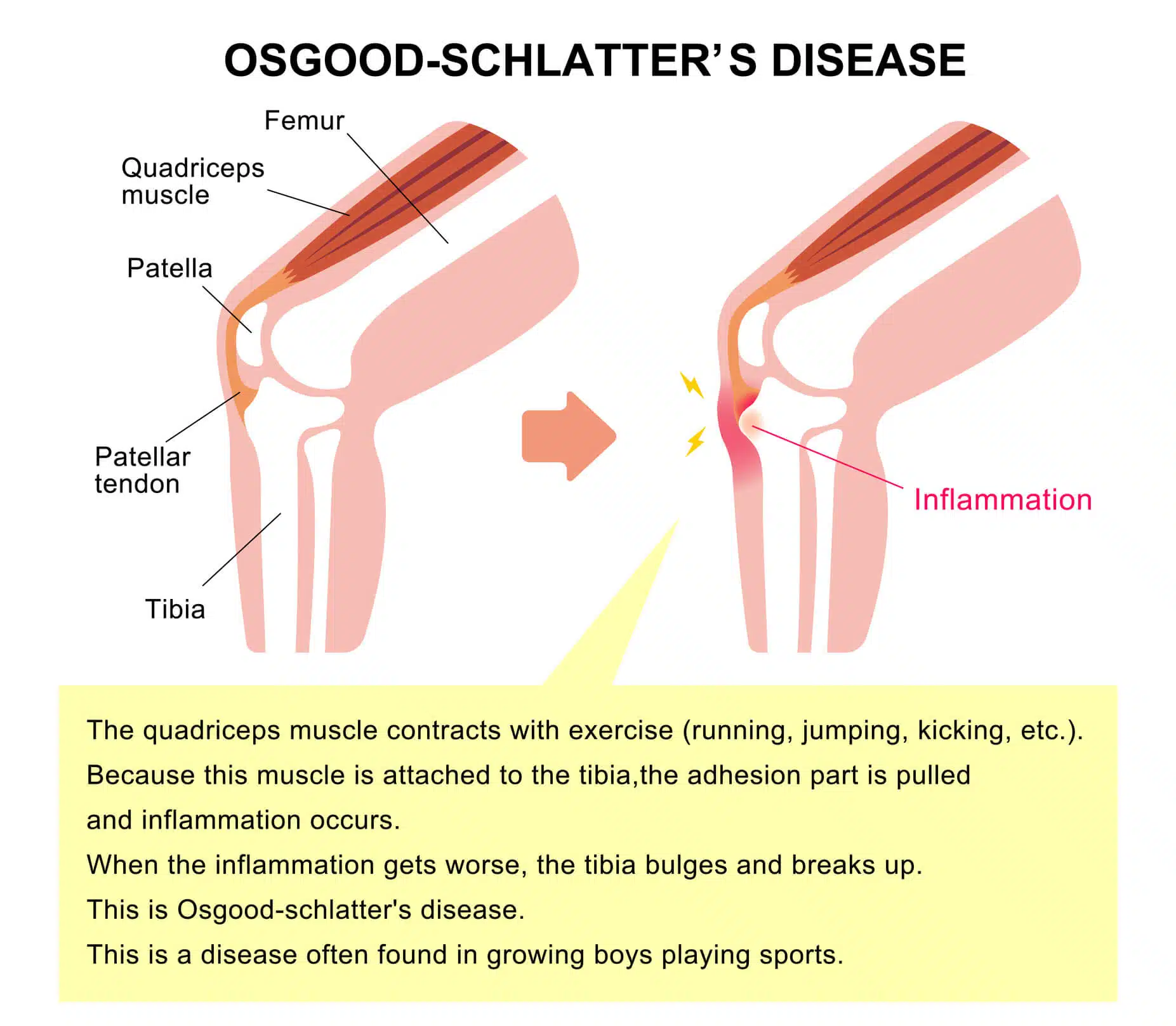 Osgood Schlatter Disease:Causes, Symptoms,Treatment · Dunbar Medical