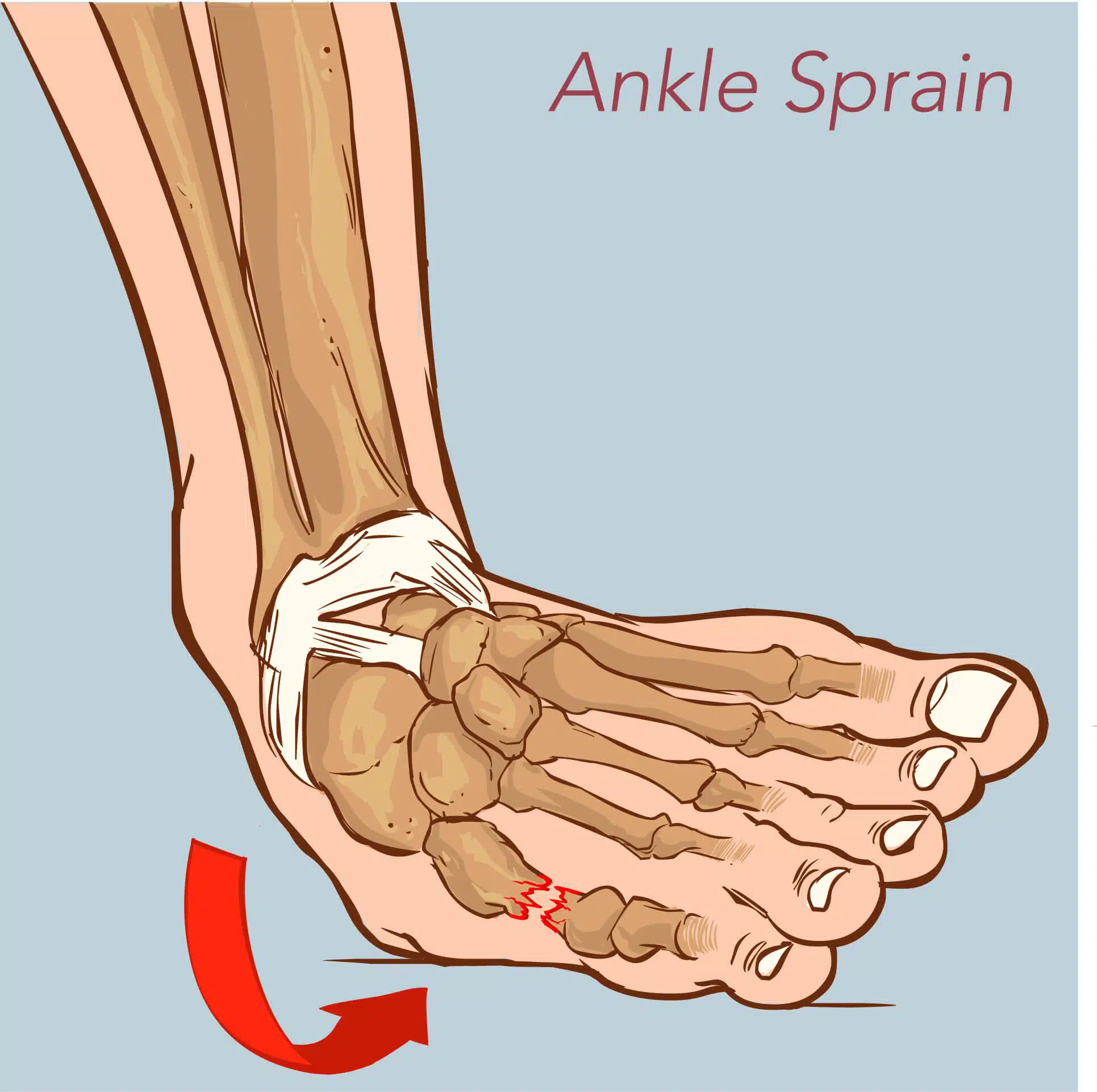 Rigid Ankle Brace, Ankle Sprain Brace
