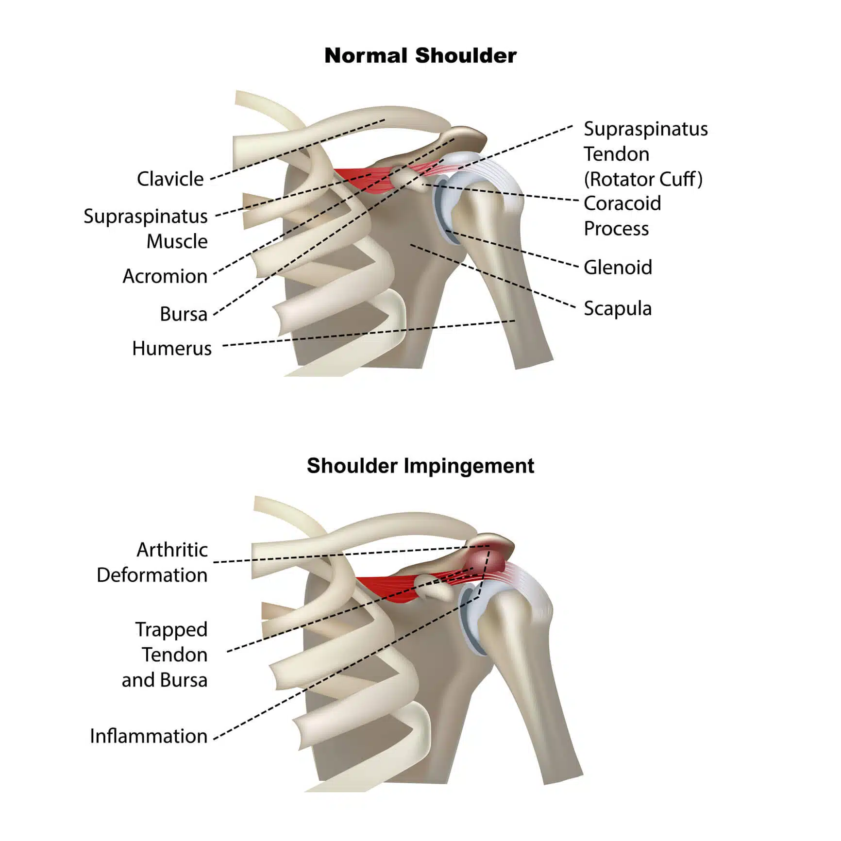 Shoulder Braces For Dislocations, Instability & Sprains · Dunbar Medical