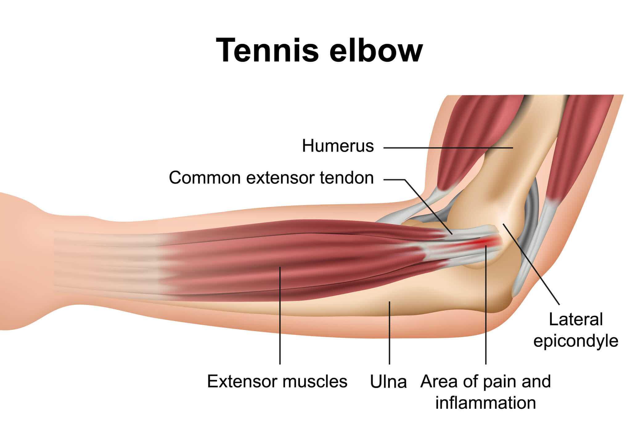 Image of an elbow affected by tennis elbow