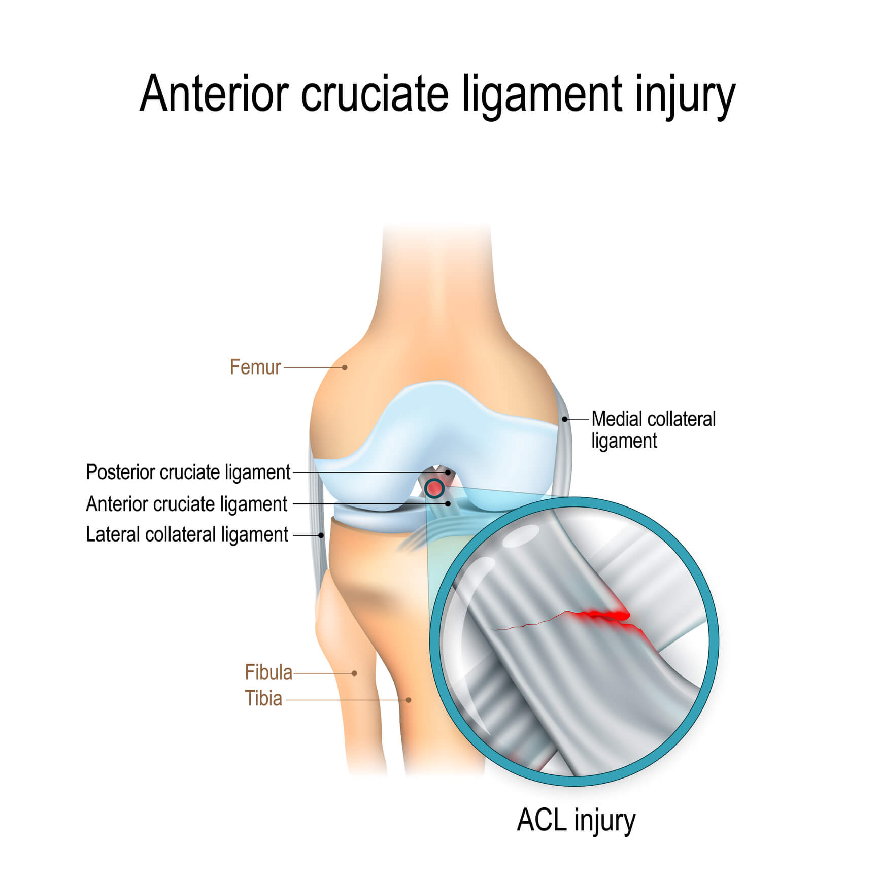 Torn ACL Injuries Causes Symptoms Treatment Dunbar Medical