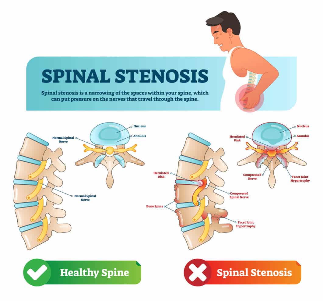 Spinal stenosis vector illustration. Labeled medical scheme with explanation. Diagram with normal spinal nerve, nucleus, annulus, bone spurs and compressed spinal nerve. Cause of back and neck pain.