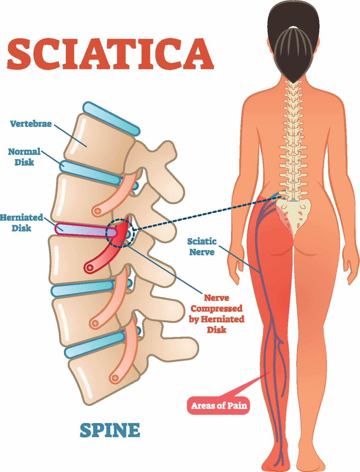 Medical diagram of the sciatic nerve and sciatica