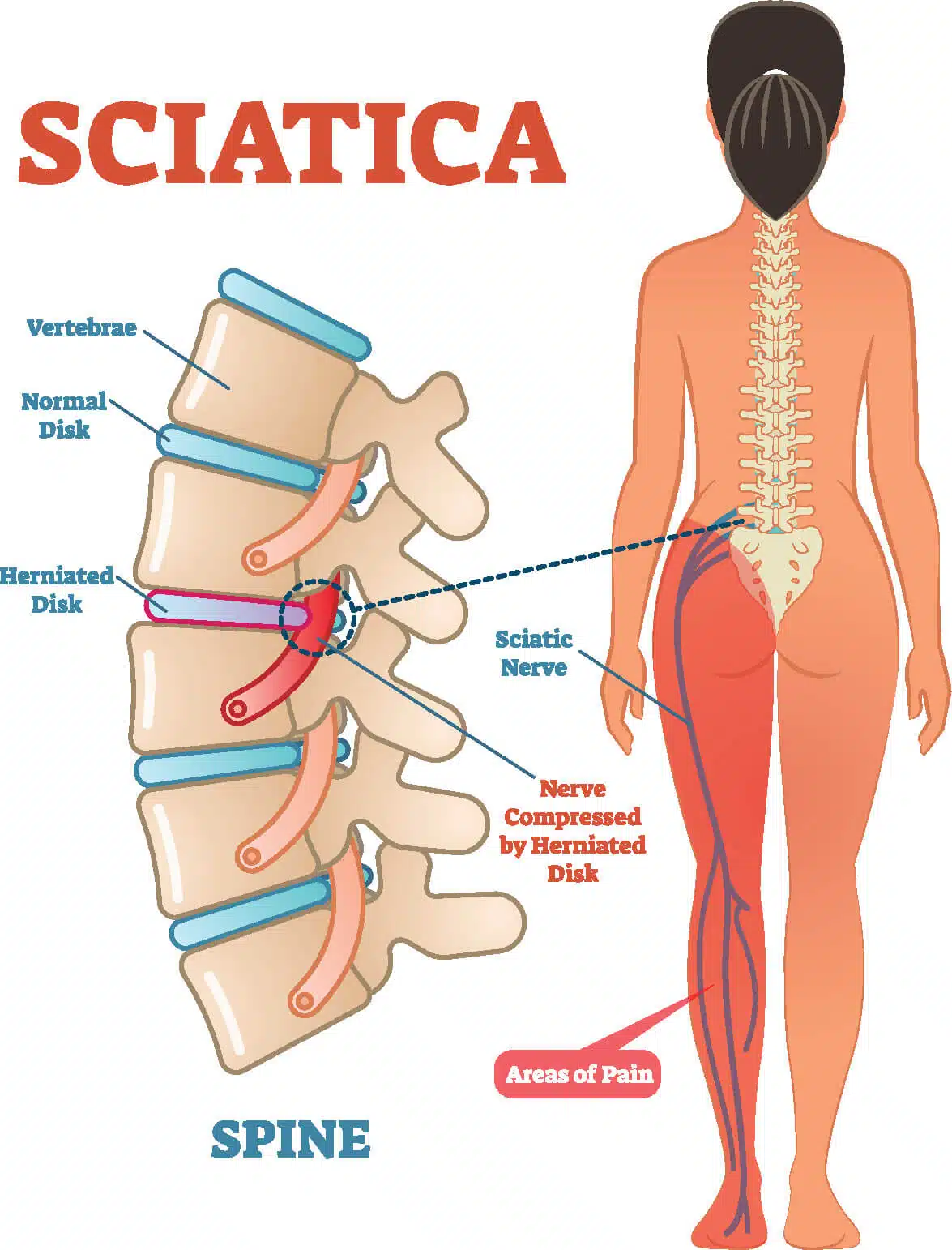 How to Manage Your Sciatica Pain While Driving