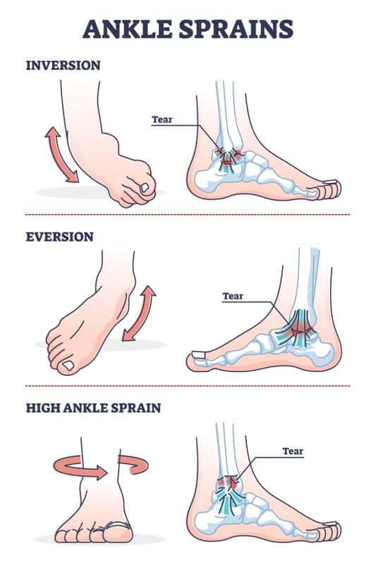 Medical image showing the three types of ankle sprain (inversion, eversion and high ankle).